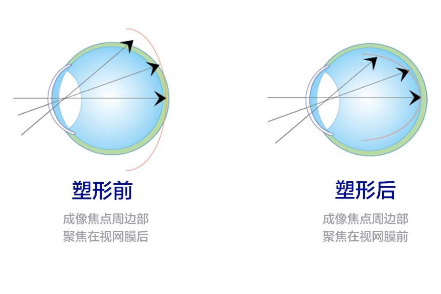角膜塑形鏡OK不OK？福州銳明愛(ài)爾眼科專(zhuān)家來(lái)解答