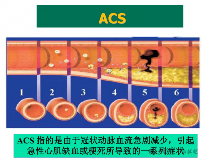 心梗猝死常突發(fā)，步長(zhǎng)青花瓷腦心通膠囊穩(wěn)定斑塊“可救命”--研究證實(shí)